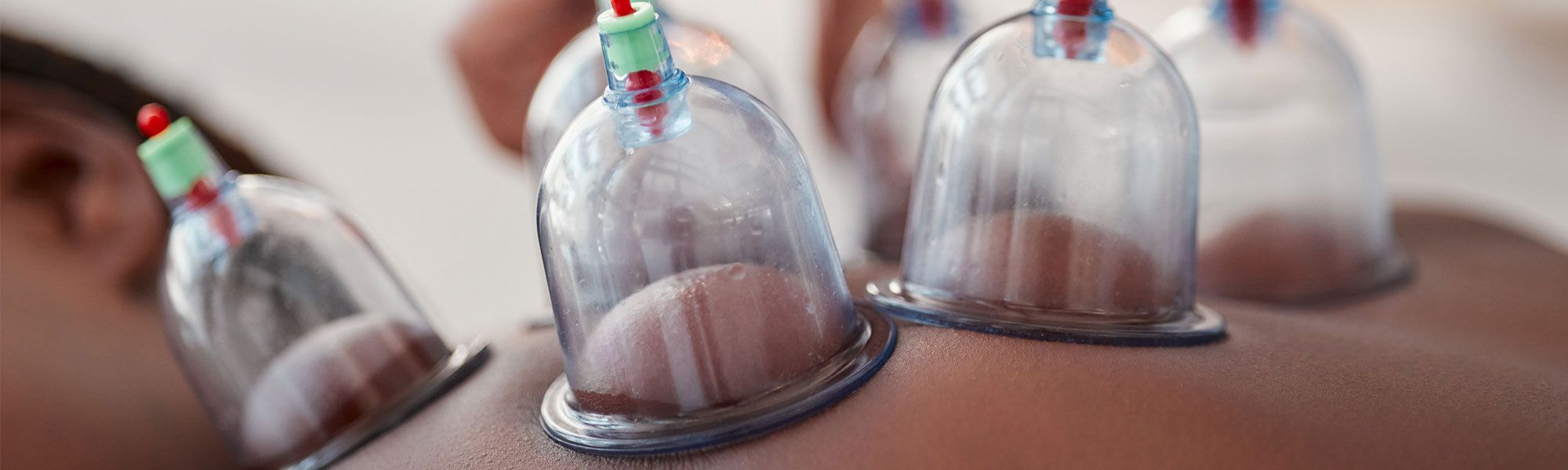 La coppettazione Rimini